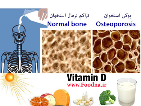 پوکی استخوان