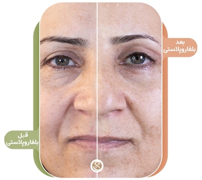 کرم ترمیم کننده بعد از بلفاروپلاستی